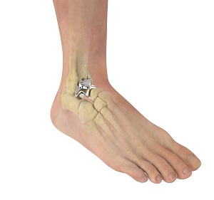 Total Talus Replacement