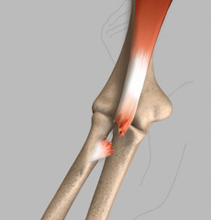 Bicep Tendon Tear at the Elbow - pic