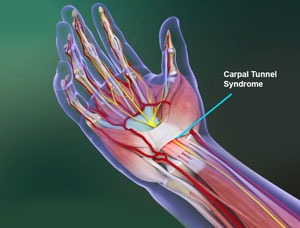 Carpal Tunnel Syndrome - pic