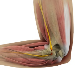 Cubital Tunnel Release (Medial Epicondylectomy) - pic