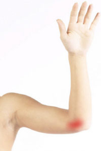 Cubital Tunnel Syndrome (Ulnar Nerve Entrapment) - pic