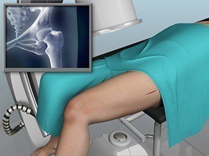 Direct Anterior Hip Replacement pic