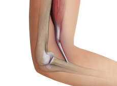 Distal Biceps Injuries - pic