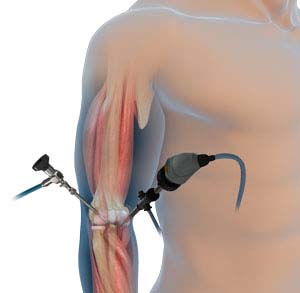 Elbow Arthroscopy - pic