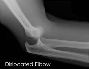 Elbow Dislocation - pic