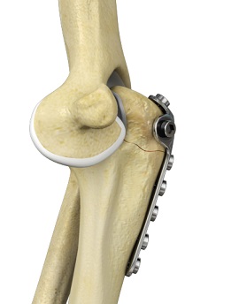 Elbow Fracture Reconstruction - pic