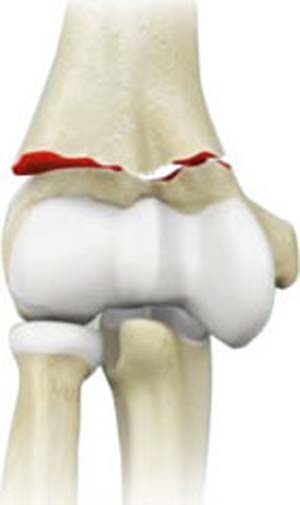 Elbow Fractures - pic