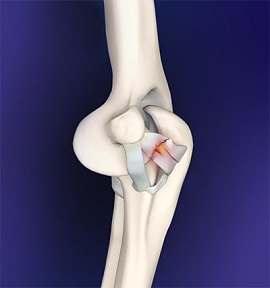 Elbow Ligament Reconstruction - pic