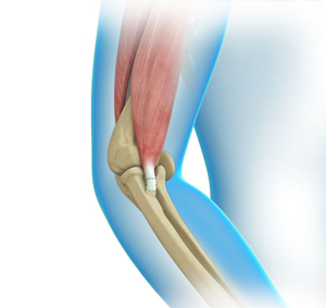 Elbow Tendon and Ligament Repair - pic