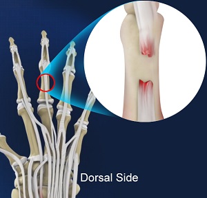Extensor Tendon Injuries - pic
