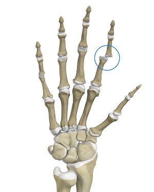 Finger Dislocation - pic