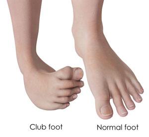 Foot Injections pic