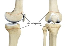 Growth Plate Fracture - pic