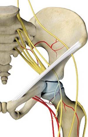 Avascular Necrosis pic