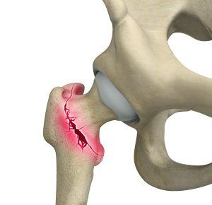 Hip Fracture pic