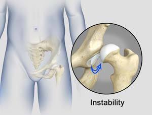 Hip Instability pic
