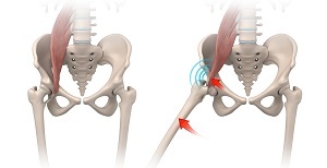 Iliopsoas Impingement pic