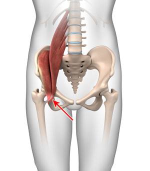 Iliopsoas Tendonitis pic