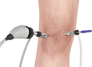 Knee Arthroscopy pic