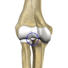 Loose Bodies in the Elbow - pic