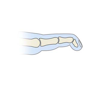 Mallet Finger - pic