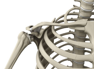 Reverse Shoulder Replacement - pic