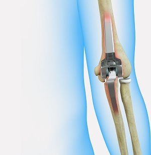 Revision Elbow Replacement - pic