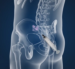 Sacroiliac Joint Injections pic