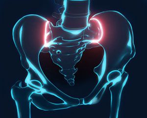 Sacroiliitis - pic