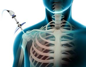 Shoulder Arthroscopy - pic