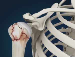 Shoulder Fracture - pic