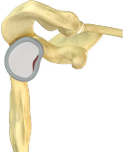 Shoulder Labral Tear - pic