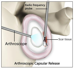 Shoulder Stiffness Surgery - pic