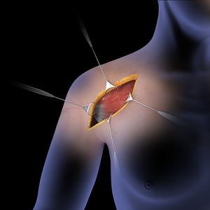 Shoulder Surgery - pic