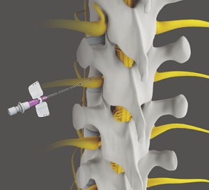Spine Injection - pic