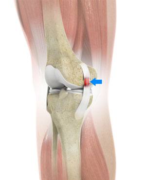 Sprains and Strains - pic