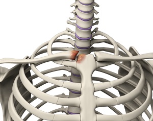 Sternoclavicular Arthritis - pic