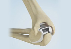 Total Elbow Replacement - pic