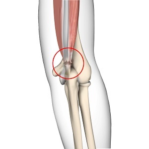 Triceps Injuries - pic
