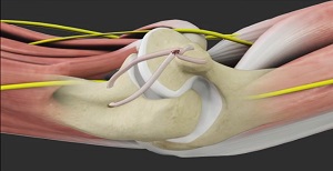 UCL Reconstruction (Tommy John Surgery) - pic