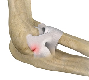 Ulnar Collateral Ligament (UCL) Injury - pic