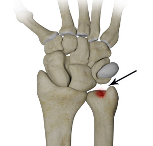 Ulnar Wrist Pain - pic