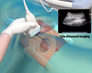 Ultrasound Guided Injections - pic