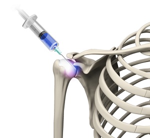 Viscosupplementation for Shoulder Arthritis - pic