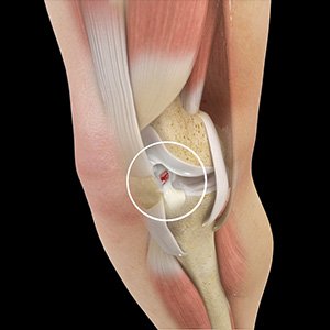 Picture of ACL Tears