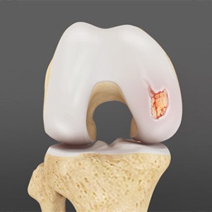 Picture of Articular Cartilage Injury (Knee)