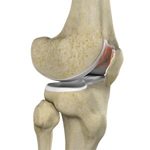 Picture of Chondromalacia Patella