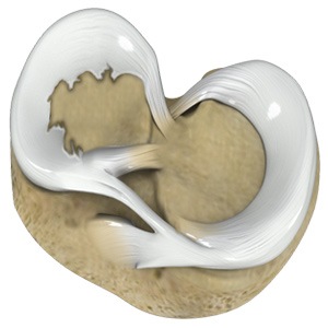 Picture of Degenerative Meniscal Tears