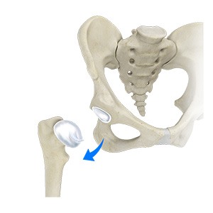 Picture of Hip Dislocation