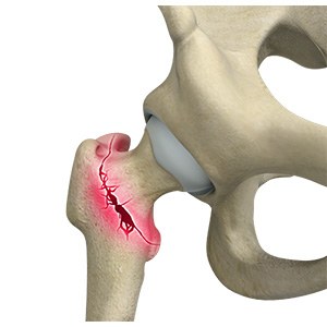 Picture of Hip Fracture
